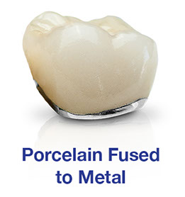 Porcelain Fused to Metal