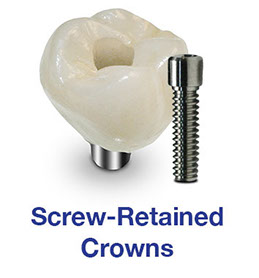 Screw-Retained Crowns